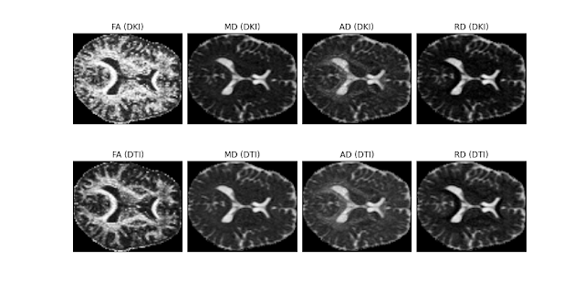 Diffusion_tensor_measures_from_DTI_and_DKI