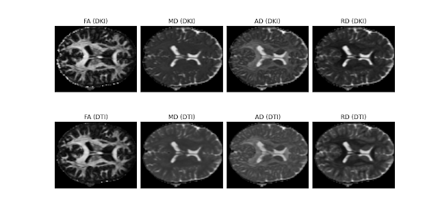 Comparison of DKI and DTI measures
