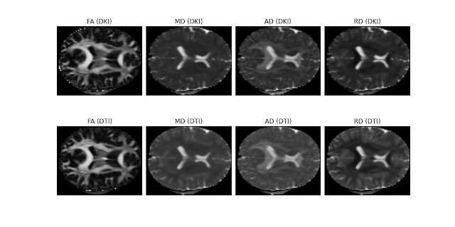 Improved DKI and DTI Comparison