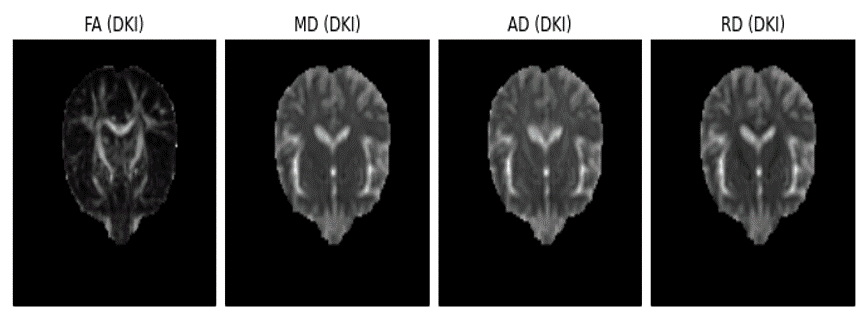 Real brain standard diffusion tensor measures