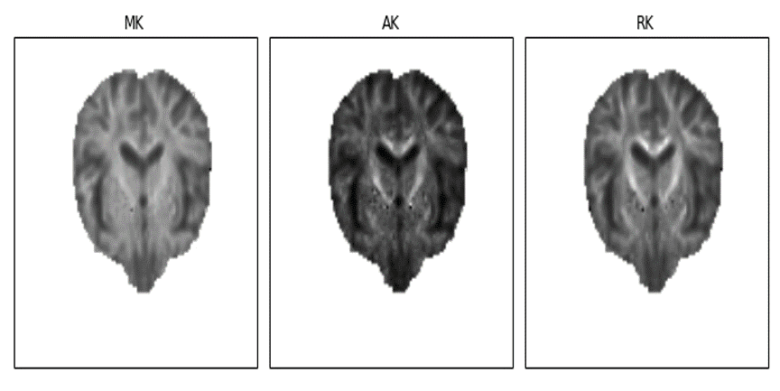 Real brain standard kurtosis tensor measures