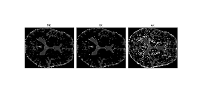 Real brain standard diffusion tensor measures